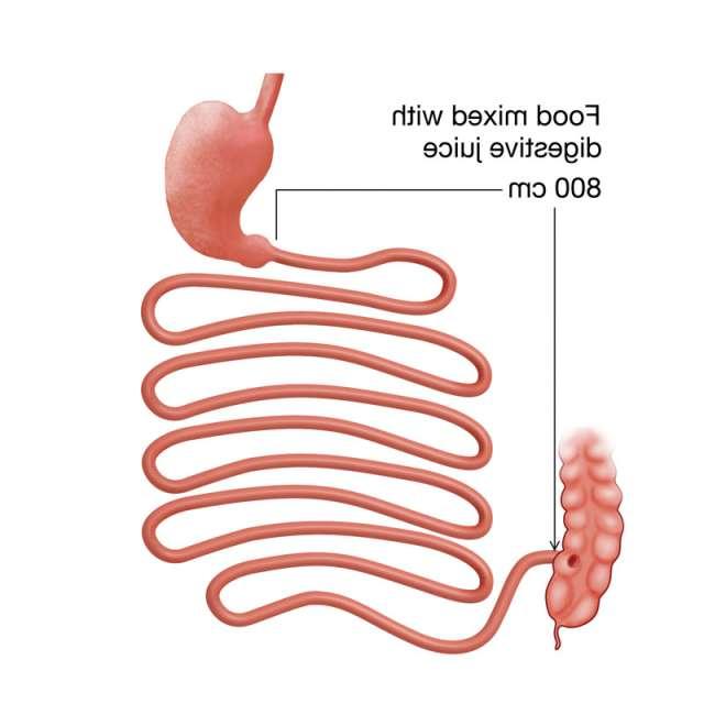 Gastric Bypass Revison